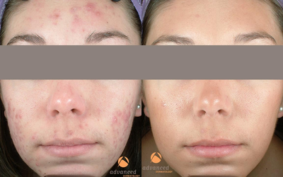 Female treated with 4 Photodynamic Therapy with Levulan for acne - 
	Photodynamic therapy (PDT) is the use of light or laser energy to act against acne.
