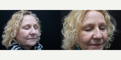 45-54 year old woman treated with Thermage FLX - 45-54 year old woman treated with Thermage FLX around the eye area