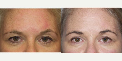 Botox to Balance uneven eyebrows - Micro-Botox can be used to balance uneven eyebrows and create a soft and delicate brow arch. Minute amounts of Botox are selectively placed in muscles and the skin around the brows to sculpt them.