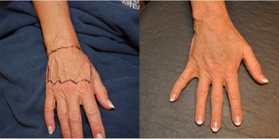 55-64 year old woman treated with Fat Transfer - Patient received Fat Transfer to her hands