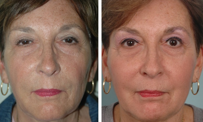 Sculptra  - 65 year old female shown before and after Sculptra into midface, nasolabial folds and cheeks.