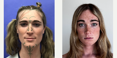 Patient treated with Facial Feminization Surgery, Transgender Facial Feminization Surgery, Rhinoplasty, Septoplasty - 25 to 34 year-old female patient is 3 months post-op from Facial Feminization surgery. Her procedures included: Forehead Lift, Hairline Lowering, Supra Orbital Bone Reduction and Contouring, Septorhinoplasty (closed) with Cartilage Grafts, Chin Reduction and Contour, Intranasal Lip Lift, Fascia to Lips, Thyroid Cartilage Shave, and 300 Micrografts to the Fronto Temporal Recessions.
