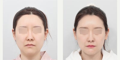 Woman treated with Liposuction, Thread Lift - Face Liposuction, Face Neck Thread Lifting (Elasticcum)