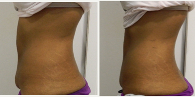 35-44 year old woman treated with i-Lipo - Female treated with 6 sessions of iLipo plus carboxytherapy