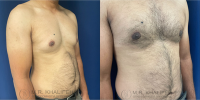 Man treated with Gynecomastia Surgery - Man treated with Gynecomastia Surgery