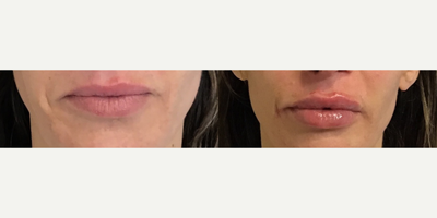 Woman treated with Restylane Kysse, Juvederm, Voluma - Woman treated with Restylane Kysse, Juvederm, Voluma
