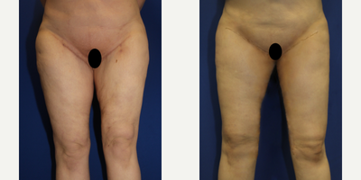 35-44 year old woman treated with Thigh Lift - This is a 36 year old White female patient who is 59 and weighed 240 pounds.  She lost 65 pounds and was not happy with her inner thighs.  She previously had a thigh lift but needed a revision.  She traveled from Philadelphia to California to have a revision of her crescent and longitudinal thigh lift with Dr. J. Timothy Katzen.  Dr. Katzen also did liposuction on her thighs.  Her thigh surgery lasted 4.5 hours and 1.6 pounds of excess skin and fat was removed.  She is very happy with the outcome.