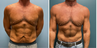 55-64 year old man treated with Male Tummy Tuck, Skin Tightening - Tummy tuck with skin tightening of chest and lateral chest wall.