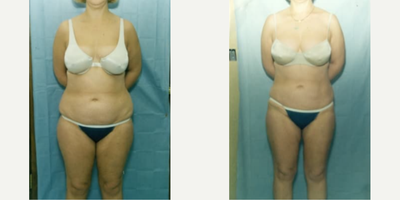 Woman treated with Smart Lipo - Woman treated with Smart Lipo