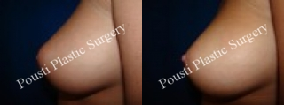 Nipple-Areola Repair - 	This 19 year old patient from Carlsbad was interested in inverted nipple repair of her left breast. She is 1 month post op inverted nipple repair