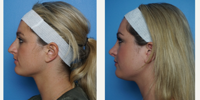 18-24 year old woman treated with Rhinoplasty - Hybrid rhinoplasty with dorsal reduction, tip refinement and straightening