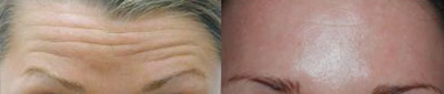 Botox - Natural Botox Cosmetic injections resulted in a smooth forehead.