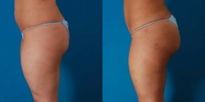 25-34 year old woman treated with Butt Augmentation - Procedure: Liposuction of abdomen, flanks, arms, and axillae, and buttock fat injection, and touch up 4.5 months later.Before, 2.5 months after her second fat injection procedure.