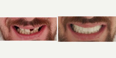 35-44 year old man treated with Dental Bridge - x10 Composite Bonding Restoration