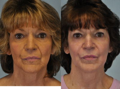 Full Face Hetter Peel - 
	This patient underwent a full face Hetter Peel.
