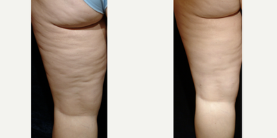 35-44 year old woman treated with Cellulaze - Grade III cellulite with one treatment of Cellulaze