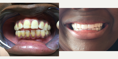 25-34 year old woman treated with Porcelain Veneers - Patient presented with stained teeth and an open bite, as a result of failed braces.  Patient's smile was completely redesigned and corrected by Dr. Sarah Thompson in just 2 appointments in-office.&nbsp;