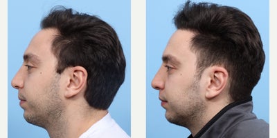 25-34 year old man treated with FUE Hair Transplant, Hair Transplant, Hair Loss Treatment, PRP for Hair Loss, PRP Injections - Dr. Wise performed an FUE hair transplant on this patient to restore his hairline. During the procedure he placed 2,250 grafts in zone 1 of the scalp and did one treatment of PRP injections.