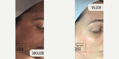 Woman treated with VI Peel - A brighter, more even skin tone after two VI Precision Plus peels!