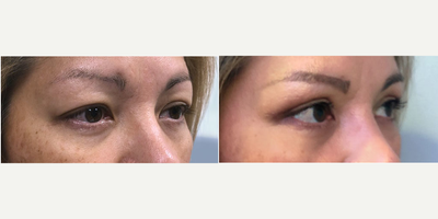 45-54 year old woman treated with Eyelid Surgery - The patient is a 45-55 year old female with a bilateral upper & lower eyelid lifts.