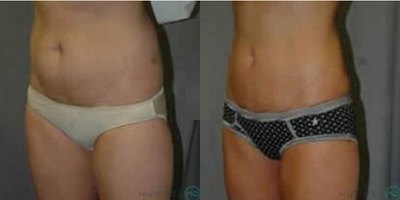 Woman treated with Body Lift - Woman treated with Body Lift