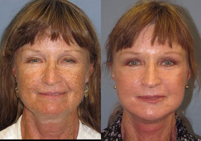 LiteLift - 
	This woman received a LiteLift. The LiteLift is a modified Facelift, that reduces signs of aging of the lower face, jawbone, and neck. Because of limited incisions there is little bruising and swelling and the recovery time is very quick, most patients can be back to work within two weeks.
