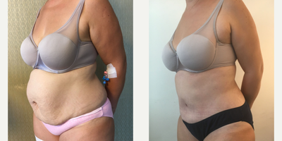 45-54 year old woman treated with Tummy Tuck - Tummy Tuck Surgery performed by DR. Ozge Ergun