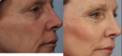 Cheek fat transfer - Fat grafting was performed to the cheeks to replace volume lost with age
