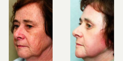 Woman treated with Laser Resurfacing - Woman treated with Laser Resurfacing