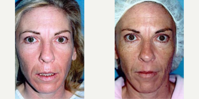 Woman treated with Laser Resurfacing - Woman treated with Laser Resurfacing through dermabrasion of upper lip.