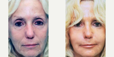 Woman treated with Laser Resurfacing - Woman treated with Laser Resurfacing