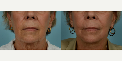 65-74 year old woman treated with Facelift, SMAS Facelift, Neck Lift, Eyelid Surgery, Brow Lift, Facial Fat Transfer, Laser Resu - At the vibrant age of 71, this patient elected to undergo several procedures with Dr. Thomas Mustoe to preserve her natural beauty and active lifestyle without an overly tight or pulled appearance. Her personalized facial rejuvenation included a deep plane facelift/minilift, neck lift, upper blepharoplasty, brow lift, and fat grafting around the mouth, all performed by the skilled hands of Dr. Mustoe in Chicago. Post-procedure results, observable just one month post-op, reflect her desire for a subtle but impactful alteration, enhancing her already attractive features while maintaining her characteristic expressions.The above patient sought to leverage Dr. Mustoe's proficiency not only in facelift/minilift techniques but also in neck lift, blepharoplasty, brow lift, and fat grafting procedures. In addition to these, laser treatment and dermabrasion were used to augment the smoothness and youthfulness of her skin near the mouth area. The successful outcome demonstrates Dr. Mustoe's commitment to meeting the patient's unique requirements. Despite her age, the patient continues to lead a vibrant life post-procedure, which highlights minimal impact on her active lifestyle due to Dr. Mustoe's careful and thoughtful approach.Known for his personalized approach and optimal results, Dr. Thomas Mustoe is an American board-certified plastic surgeon and a respected authority in the field. Renowned for conducting over 10,000 operations, Dr. Mustoe's practice, TLKM Plastic Surgery, located at 737 North Michigan Ave., Chicago, offers innovative and age-defying techniques, including the facelift/minilift procedure. The patient's experience showcases Dr. Mustoe's ability to balance surgical control and aesthetic sensitivity to deliver naturally beautiful results that satisfy the patient's desires while preserving their unique identity.