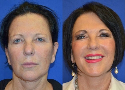 Woman on her 60's treated with Skin Rejuvenation - Woman on her 60's treated with Skin Rejuvenation