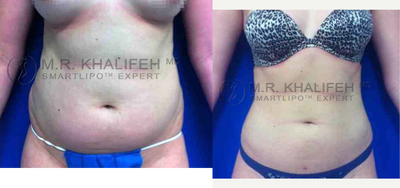 Woman treated with Vaser Liposuction - Woman treated with Vaser Liposuction