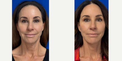 55 year old woman treated with Deep Plane Facelift - 55 year old woman treated with Deep Plane Facelift under IV Sedation.