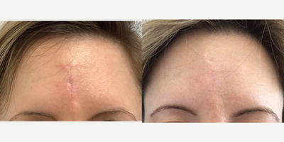 35-44 year old woman treated with Scar Removal - 43 year old woman underwent Genius Microneedling with topical Sculptra for Mohs scar