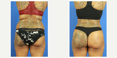 45-54 year old woman treated with Brazilian Butt Lift, Liposuction - Patient underwent 360 liposuction with fat transfer to the buttock.