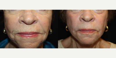 75 and up year old woman treated with Phenol Peel - 76 year old female pictured 3 months following a full face phenol peel (croton oil) to rid her undesirable deep wrinkles and facial pigmentation.
