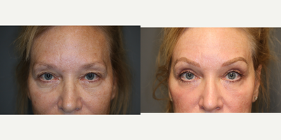 Enigmalift brow and upper eyelids. - Enigmalift to rejuvenate upper eyelids and brow with laser.