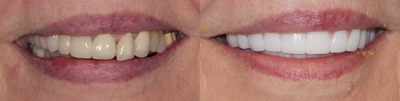 55-64 year old woman treated with ClearChoice Dental Implants - Upper and Lower Screw in Full arch teeth