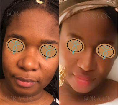 35-44 year old woman treated with African American Rhinoplasty - 
