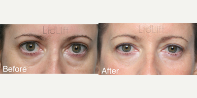 35-44 year old woman treated with Canthoplasty, Eyelid Retraction Repair, Eyelid Surgery - 44 year old woman with mild thyroid eye disease, upper eyelid retraction, and unsatisfactory upper and lower blepharoplasty.To address her concerns, she had bilateral fat only orbital decompression, upper eyelid recession surgery, crease lowering revisional upper eyelid surgery, lateral canthoplasty, and revisional lower eyelid surgery.