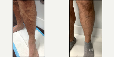 35-44 year old man treated with EVLT - He underwent EVLT and phlebectomies
