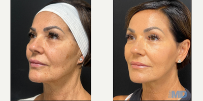 45-54 year old woman treated with NeoGen Plasma - This lovely patient is seeing tremendous improvement of her skin texture, tone and tightness.