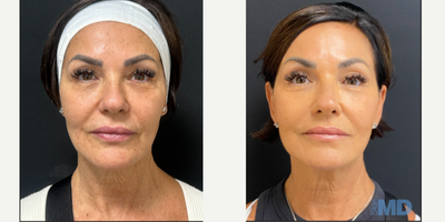45-54 year old woman treated with NeoGen Plasma - This lovely patient is seeing significant improvement on her skin tone, texture and tightness.