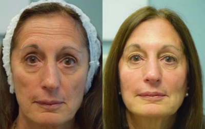 65-74 year old woman treated with Dysport - 65-74 year old woman treated with Dysport
