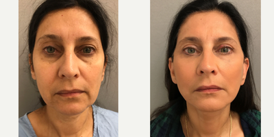 55-64 year old woman treated with SMAS Facelift - 58 y/o woman underwent S-Lift (lower facelift & includes SMAS) and upper/lower eyelid surgery in our office operating suite under sedation.