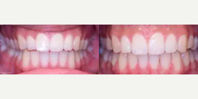 Woman treated with Invisalign - Invisalign treatment was completed to correct an uneven upper smile and to correct a front openbite. Treatment took 14 months to complete.
