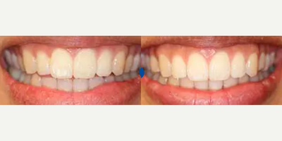 Woman treated with Invisalign - Invisalign treatment was completed to correct an uneven upper smile and to correct a front openbite. Treatment took 14 months to complete.