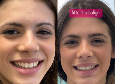 Woman treated with Invisalign - Woman treated with Invisalign
